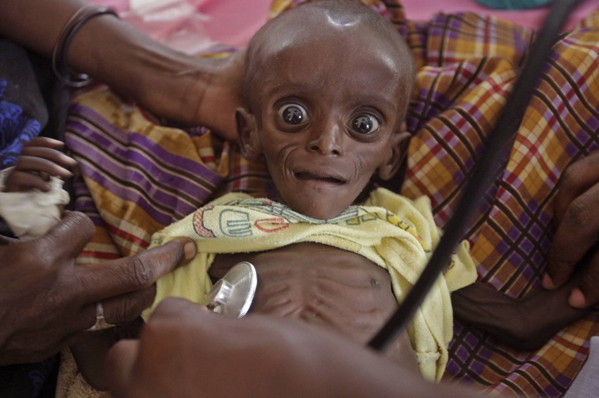 Lekar pregleda sedmomesečnog Mihaga Gedija Faraha, teškog 3,4 kilograma, u poljskoj bolnici Međunarodnog Crvenog krsta u Dadabu u Keniji