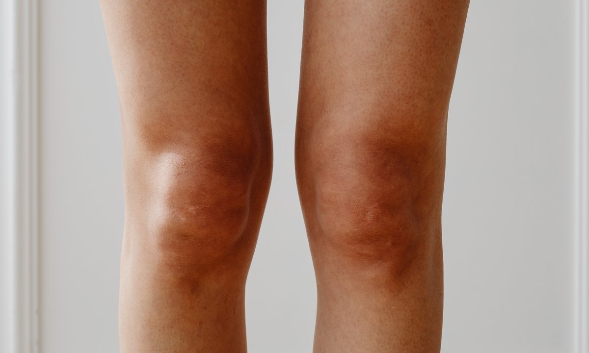 Masz takie "brudne" zmiany na kolanach i łokciach? To może być objaw choroby