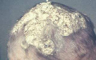 Grzybica woszczynowa - zdjęcia. Jak leczyć strupki na skórze głowy?