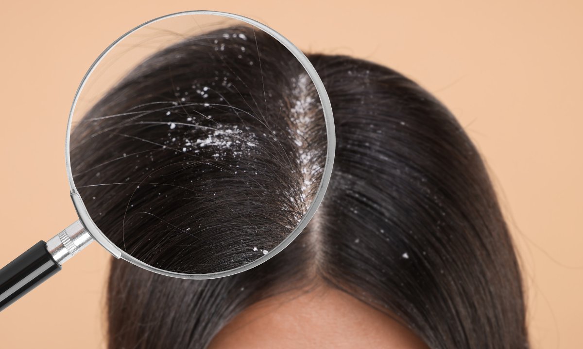 Ten szampon to likwidator łupieżu! Błyskawicznie pozbędziesz się białych płatków