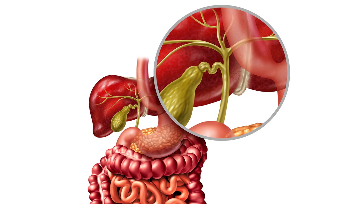 Bilijarna striktura je suženje žučnih kanala