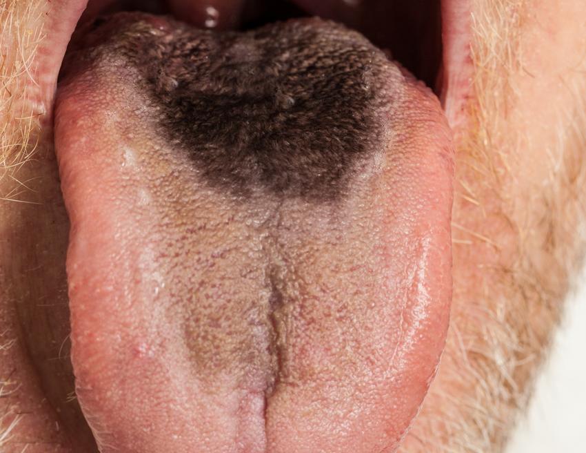 A black hairy tongue can be a very strange symptom, which is not usually accompanied by pain or discomfort, but it says a lot about our health.  These symptoms occur most often in smokers and those who neglect oral hygiene.