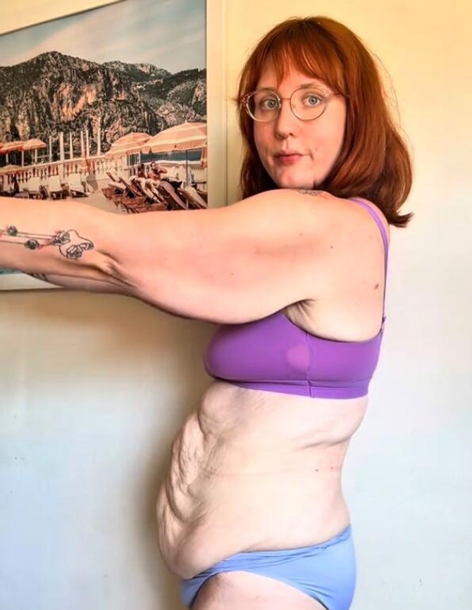 Suzan Mekginis skinula je ukupno 95 kilograma