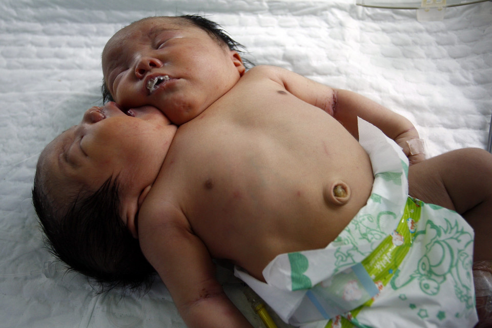 CHINA TWO-HEAD CONJOINED TWIN BABIES