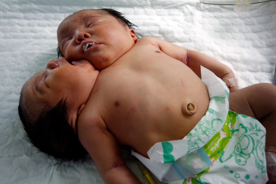 CHINA TWO-HEAD CONJOINED TWIN BABIES