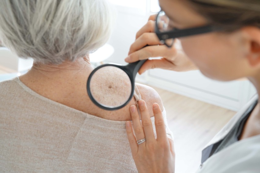 Melanoma, melanoma, carcinoma basal, tumor