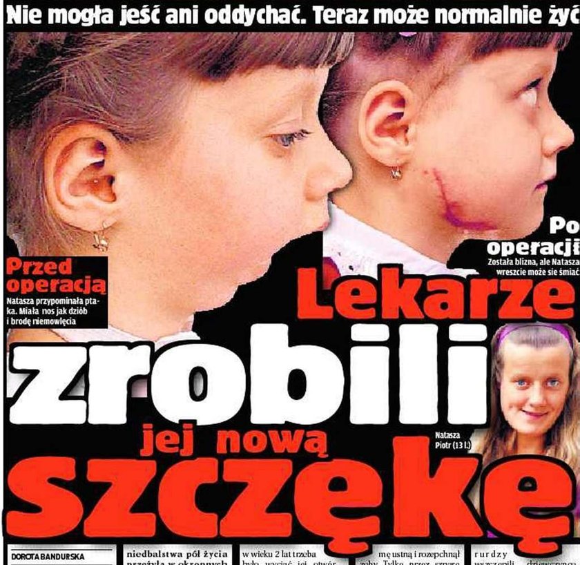 szczęka, sztuczna, operacja