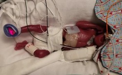 Wcześniak ważący 368 g. To jedno z najmniejszych dzieci żywo urodzonych na świecie