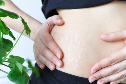 Csíkok a bőrön: striának tűnhet, pedig hormonális oka is lehet!