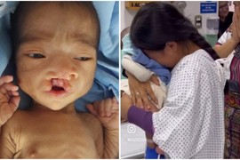 Devojčica od 14 godina rodila je sina sa RASCEPANOM USNOM i nije znala ŠTA ĆE S NJIM: Dve godine kasnije SVE SE PROMENILO - od neuhranjenog deteta postao je ZDRAV I PRELEP dečak