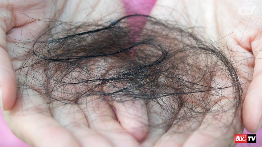 Jedan od simptoma dugog kovida je i opadanje kose