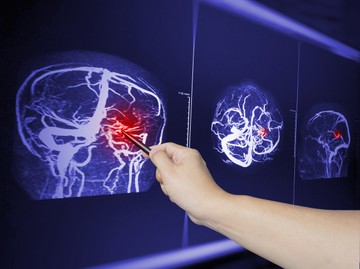 Mit jelent az agyi ödéma? Ezek az agyödéma okai, tünetei és kezelési lehetsőségei
