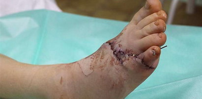 Kosiarka obcięła dziecku stopę! Lekarze ją przyszyli