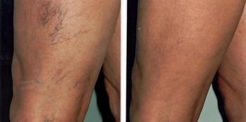 5 things you should know about spider veins