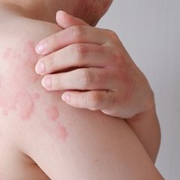 Hisztamin intolerancia: szívritmuszavar is jelezheti