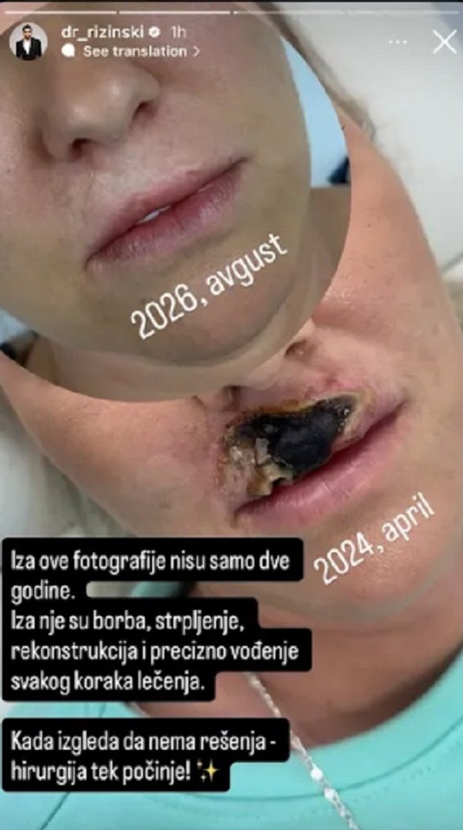 Plastični hirurg upozorio na rizik od neproverenih korekcija 
