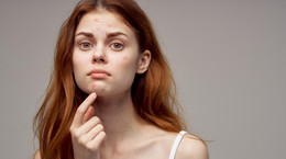 Maść na trądzik - poznaj składniki poprawiające stan skóry