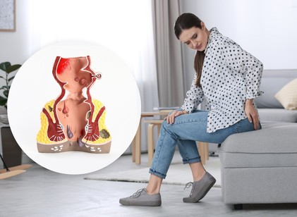 Aranyér: tévhit, hogy csak az idősek betegsége, 20 évesen is kialakulhat című cikk nyitóképe