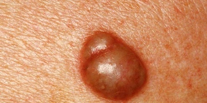 Here is how to get rid of pimples on the vagina