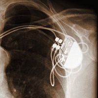 pacemaker1-d00000F5492abe12902a5