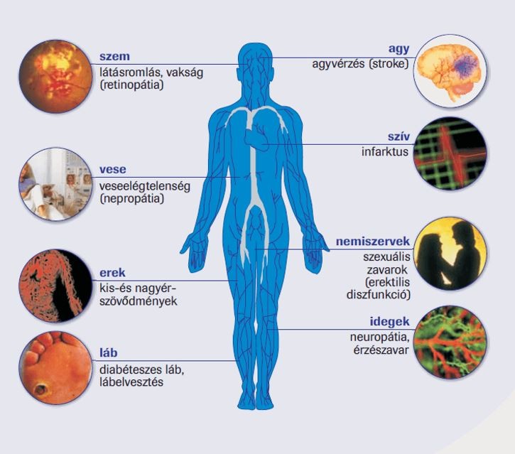 Complicaciones de la diabetes