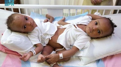 BREAKING: Conjoined Nigerian twins successfuly separated in Saudi Arabia