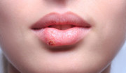  Opryszczka na ustach - przyczyny, objawy, leczenie. Maści na opryszczkę 