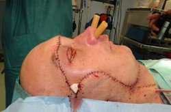 Pacjent z przeszczepioną twarzą ma się coraz lepiej