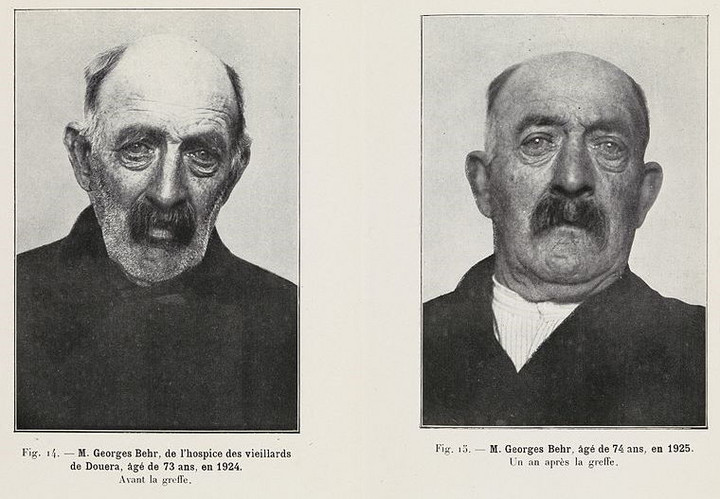 Jeden z pacjentów Woronowa przed i po zabiegu, 1924 r.
