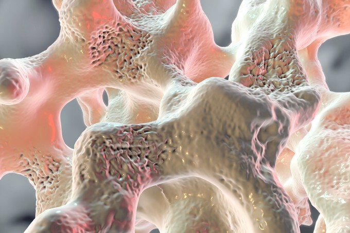 Mi az osteoporosis? Ezek a csontritkulás okai, tünetei és kezelési lehetőségei