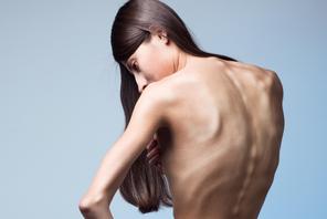 Anoreksja najczęściej dotyczy kobiet, które dużo silniej niż mężczyźni negatywnie odczuwają swoje ciało. Fot. Den Rise/Shutterstock 