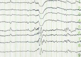 Az elektroenkefalogram (EEG) | EgészségKalauz