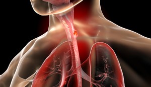 Pacijenti bez vidljivog Barrett-ovog jednjaka imali su uznapredovali rak u istraživanju 