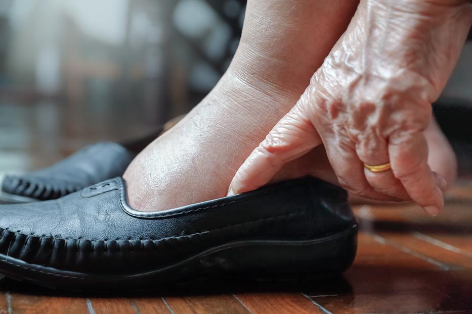 Mit tehetünk a lábdagadás ellen? Ez az egyperces módszer segíteni fog. Fotó: Getty Images