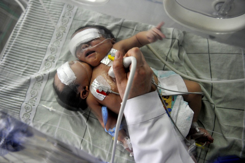 CHINA TWO-HEAD CONJOINED TWIN BABIES