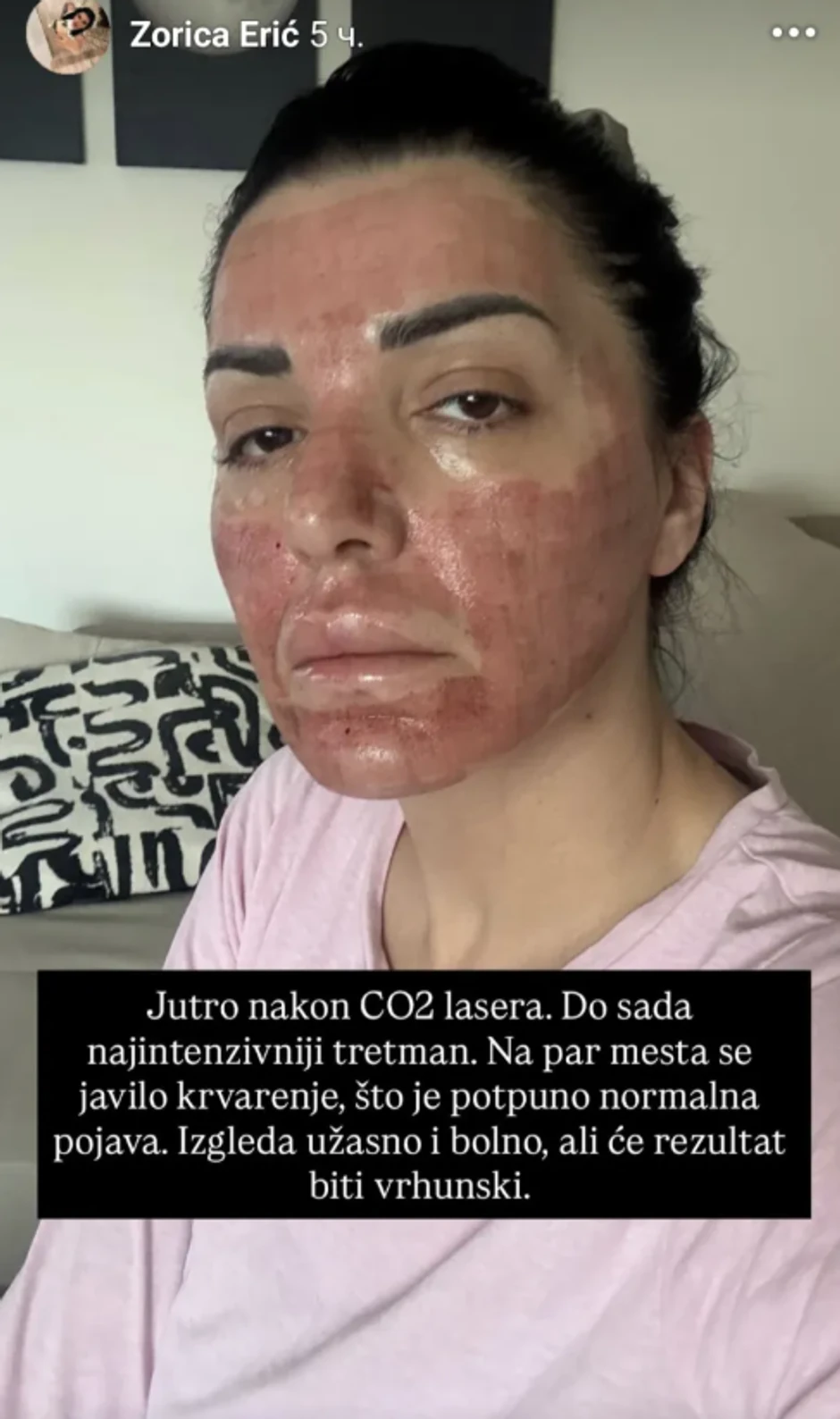 Zorica Erić nakon tretmana