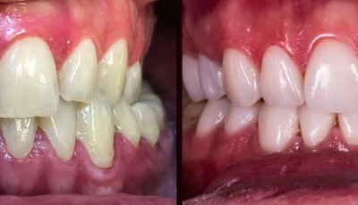 Nakładki na zęby - rodzaje, wskazania, wady i zalety