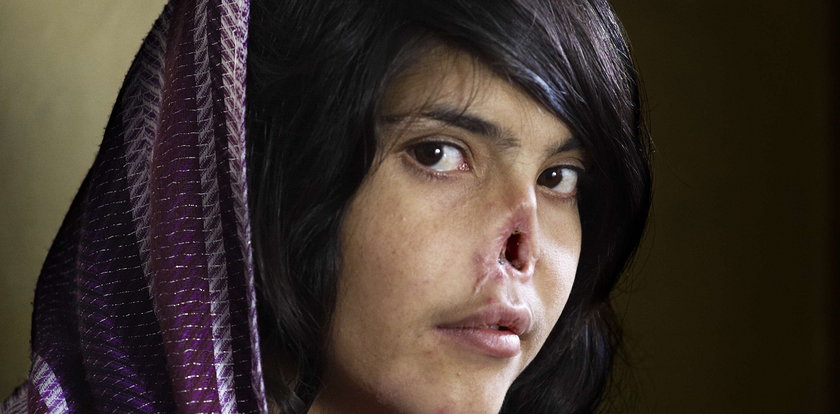 Afganka odzyskuje twarz okaleczoną przez męża