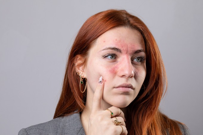 Felnőttkorban is kialakulhat ekcéma: ezeket teheti ellene