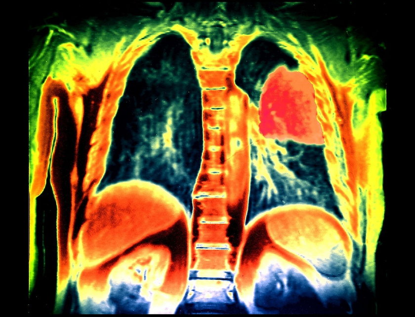 Rak płuc w 95 proc. dotyczy palaczy