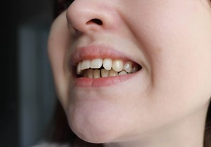 Većina slučajeva malokluzije je nasledna