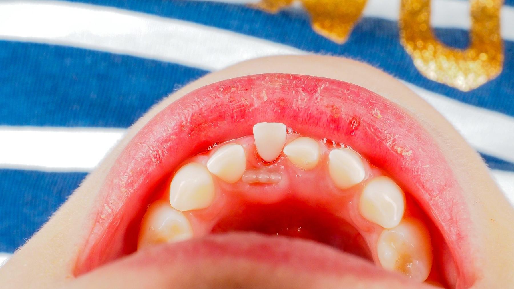 Kedy vypadávajú mliečne zuby? V akom poradí, ktorý vypadne a čo všetko  treba vedieť, vysvetľuje zubárka | Najmama.sk