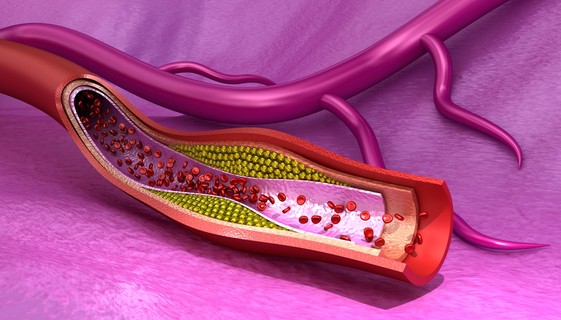Stroke és artériás trombózis - 10 másodperc alatt kialakulhat