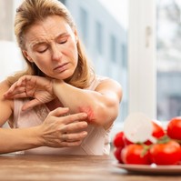Ételallergia és allergiás kiütések: ezt üzeni a bőr az immunrendszerünkről