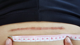 I used Contractubex on the surgical scar for seven weeks.  Has his appearance improved? 