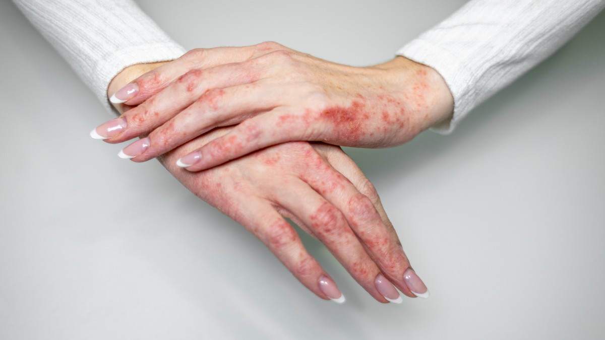 Kako nastaje i kako se leči psorijaza