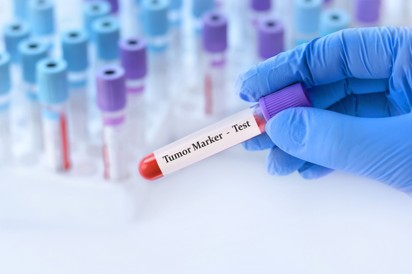 Nőgyógyászati daganatok - ekkor érdemes ellenőriztetni a tumormarkereket