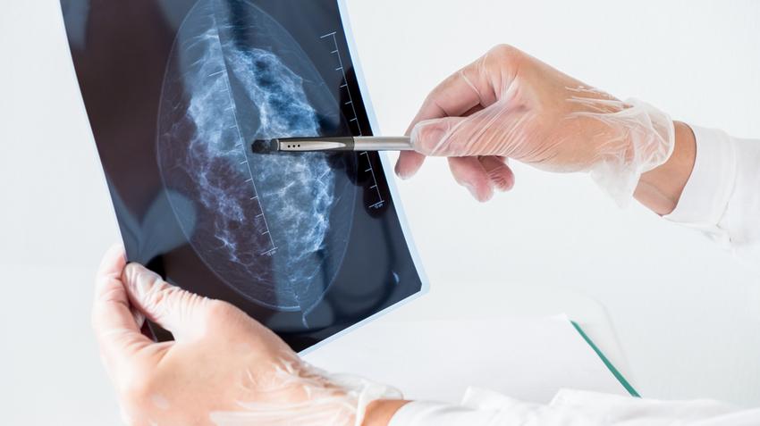 mellrák tünete emlőrák jele ajánlott vizsgálat nőknek