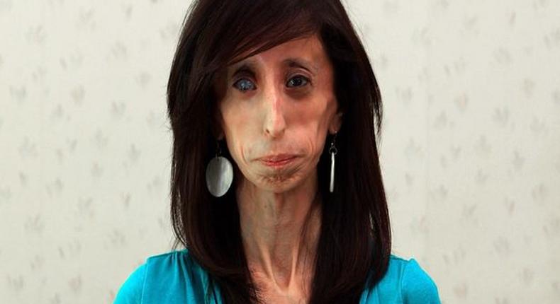 Lizzie Velasquez