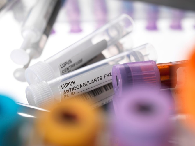 Lupus se najčešće javlja se od 16 do 44. godine života, a 90 odsto obolelih su žene